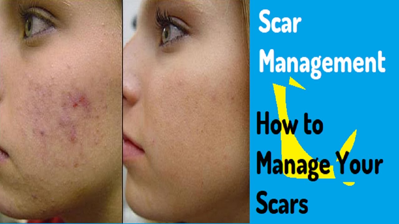 Scar Management Program Scar Management | How to Manage Your Scars | Managing Scars: The ...