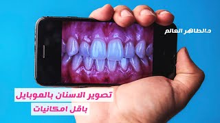 تصوير الاسنان بالموبايل وباقل امكانيات mobile dental photography