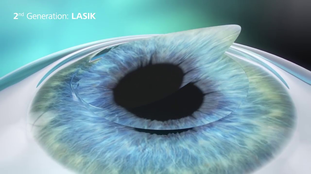 What is the difference between PRK, LASIK and ReLEx SMILE - YouTube