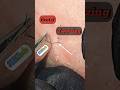 Deep Stuck Beard Hair — Satisfying Tweezing Pull