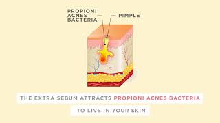 Find Out How Acne Forms Under The Skin and The Proper Treatments