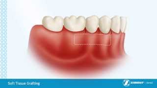Soft Tissue Grafting