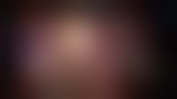 IRSL19 - Robot Assisted Laparoscopic Partial Nephrectomy for endophytic renal tumor