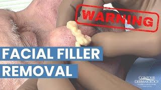 Removing YEARS OLD Facial Filler ⚠ Be careful where you get fillers from ⚠ | CONTOUR DERMATOLOGY