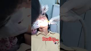 dental scaling... #dentalartistr#shorts #ytshorts #like #shortvideo#subscribe #scaling 🦷😁... .