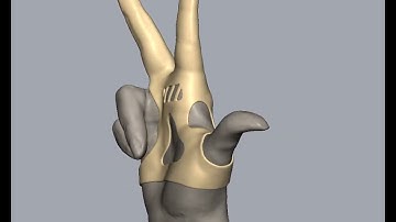 Brace Design using Geomagic FreeForm