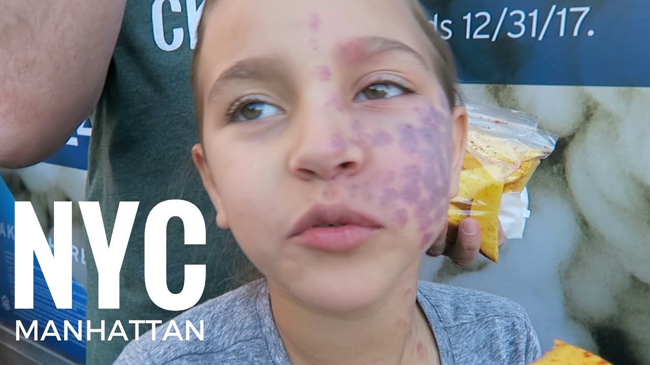 PORT WINE STAIN TREATMENT | LOST iPHONE!!!