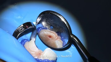 Incisor fracture: NeoMTA Cvek pulpotomy and fragment rebonding