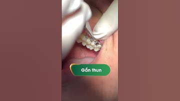 Cách xử lý mắc cài bị rớt khi niềng răng tại nha khoa