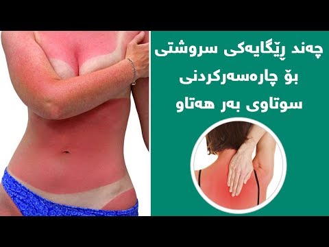 چەند ڕێگایەکی سروشتی بۆ چارەسەرکردنی سوتاوی بەرهەتاو 