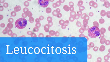 ¿Es curable la leucocitosis?