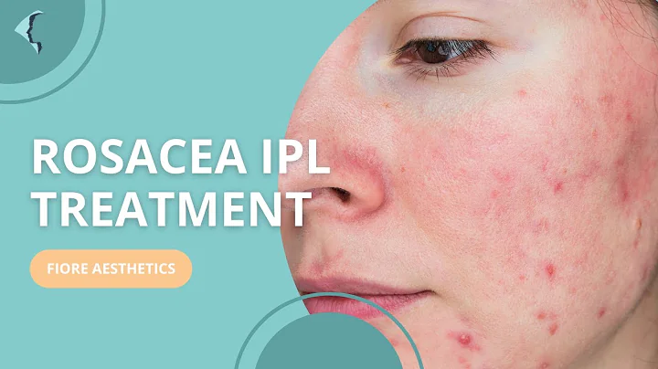 Rosacea IPL Treatment - Fiore Aesthetics