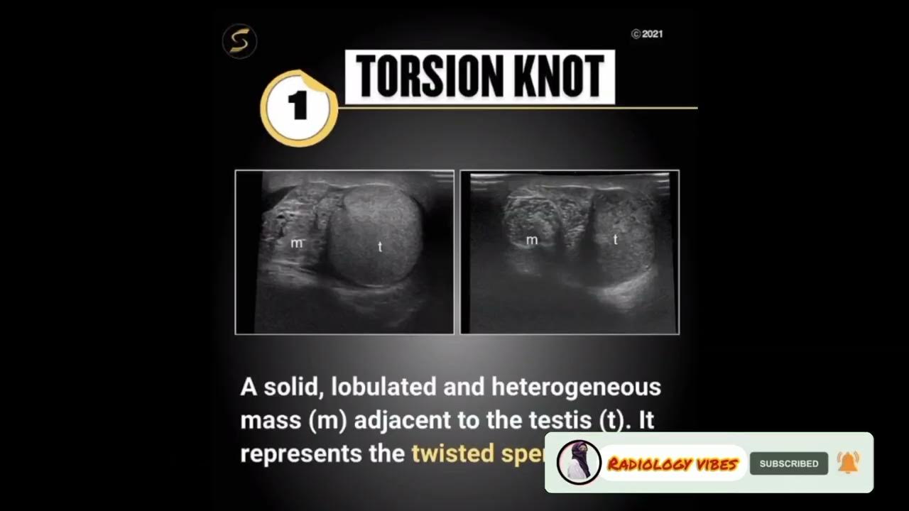 scrotal-cancer-ultrasound-testicular-ultrasound-ultrasound-course-youtube