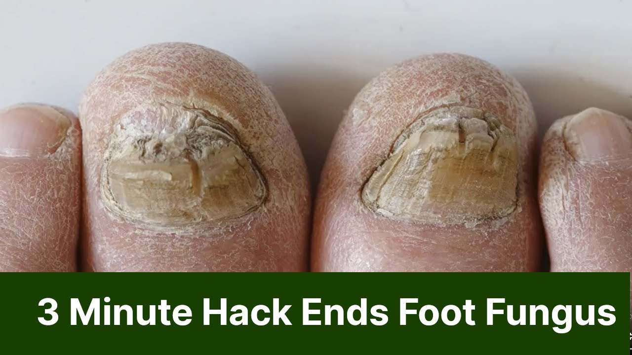 3 Minute Shower Hack Kills Fungus (prescription for fungus feet) YouTube