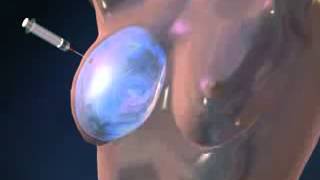 Chirurgie esthetique tunisie - Reconstruction mammaire screenshot 1