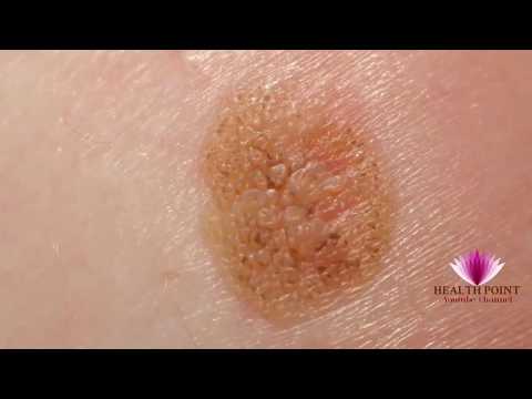 Melanoma Pictures - Signs, Symptoms, Causes, Photos, Images, Pictures Of Melanoma Skin Cancer