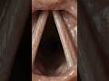 Hiccups #healtheducation