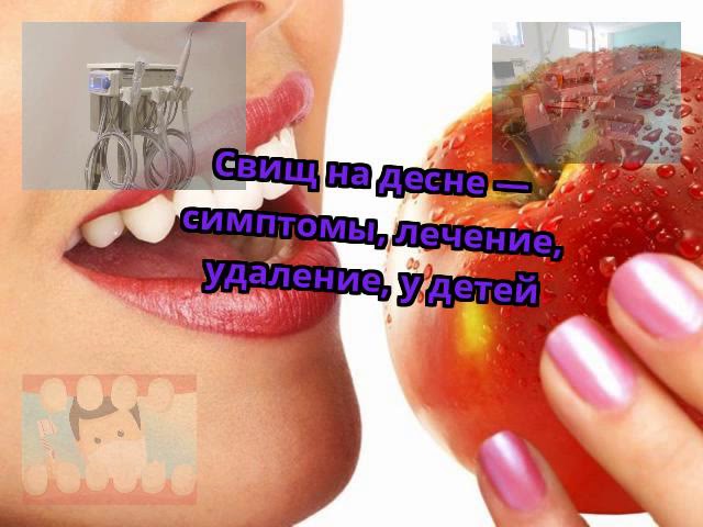 Свищ на десне — симптомы, лечение, удаление, у детей