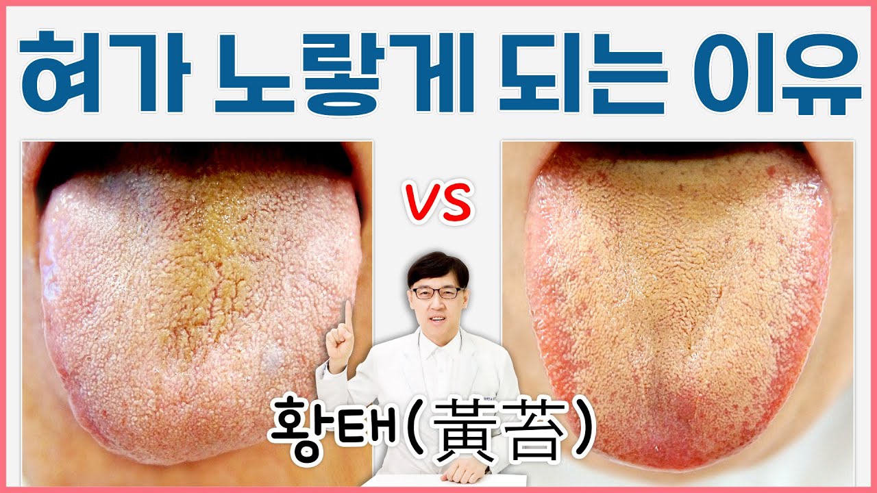 혀통증 혀황태 원인/ 혀에 백태가 노랗게 변했어요 - YouTube