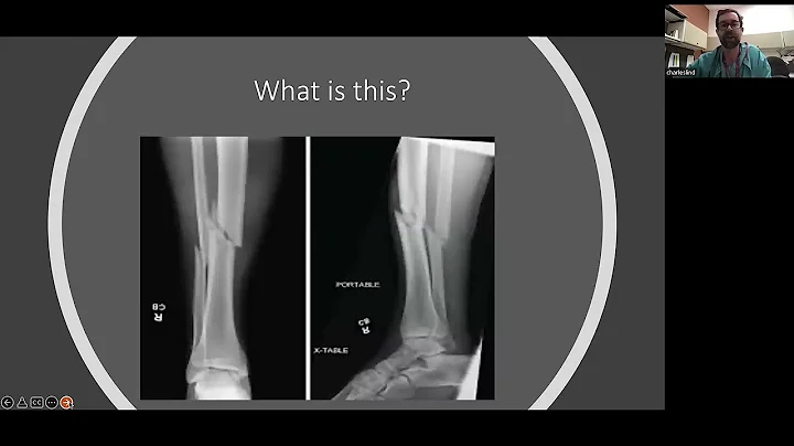 Acute Knee Injuries