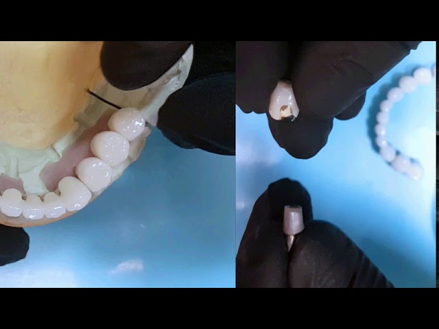 What Dental Implant Crowns Look Like from the Lab | Implant Specialist Milton, Oakville, Burlington