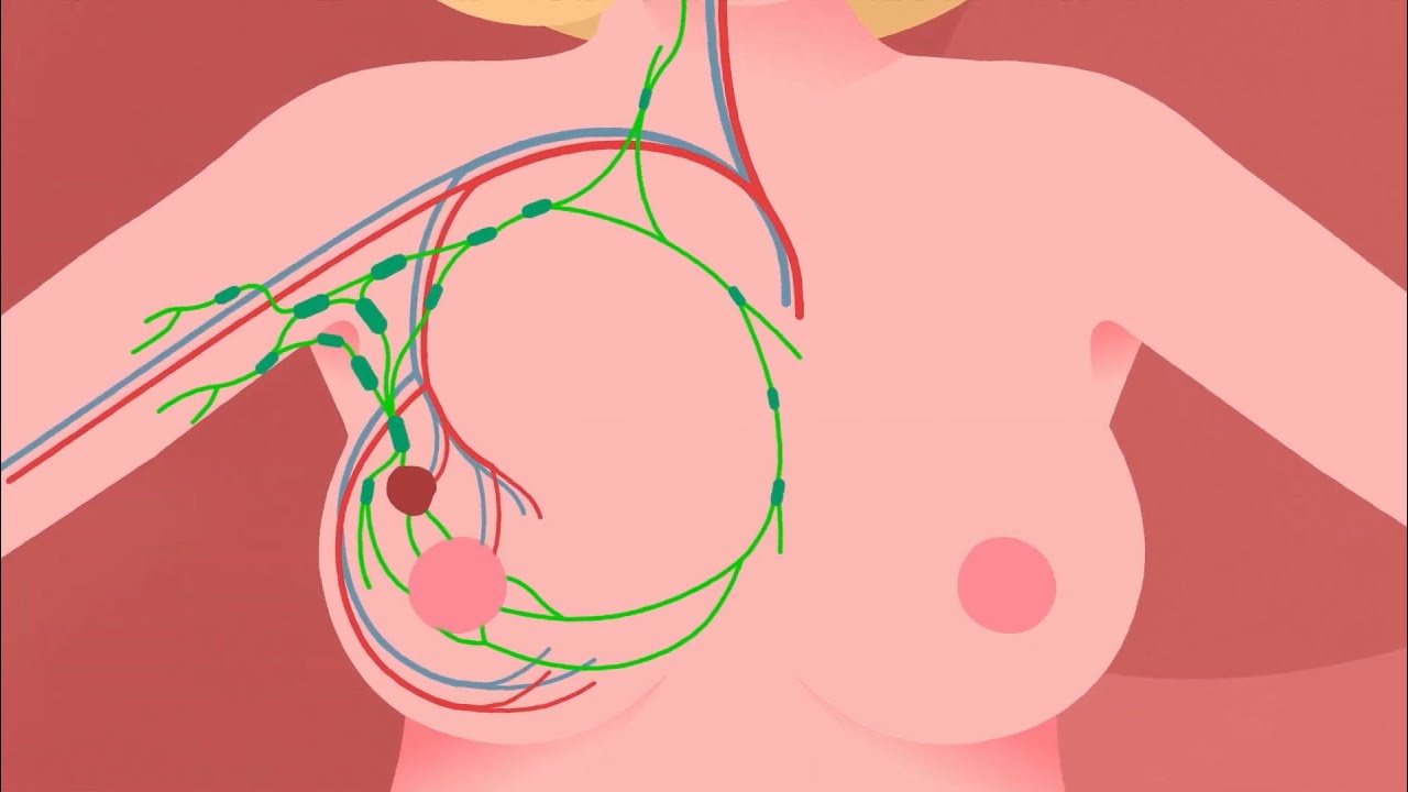 Quand faut il consulter pour un problèmes de seins? : symptômes,  traitement, définition 