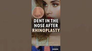 Dent in the Nose after Rhinoplasty? Don