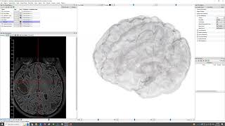 Automatic MRI brain tumor and tissue segmentation