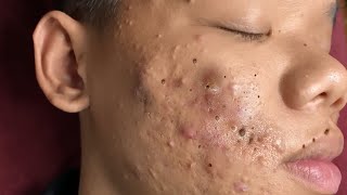 Make your Acne Treatment Huong Da Nang | 448# Hoang Part 3 | acne 2022