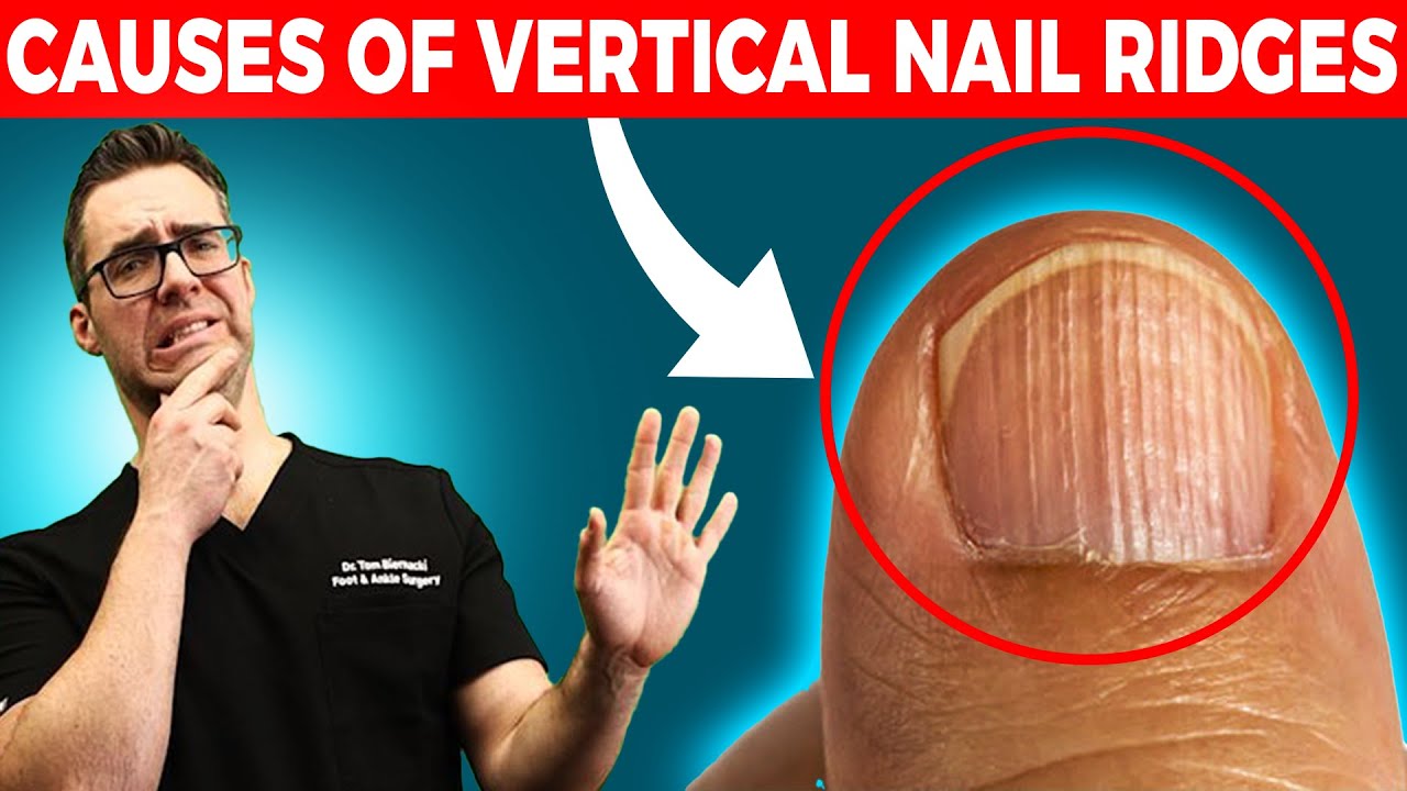 🖐Do you have Vertical Nail Ridges?  [Causes & Treatment]🖐