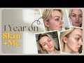 Skin  me 1 year review  clearing my pigmentation