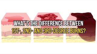 What's the difference between 1st-, 2nd- and 3rd-degree burns?