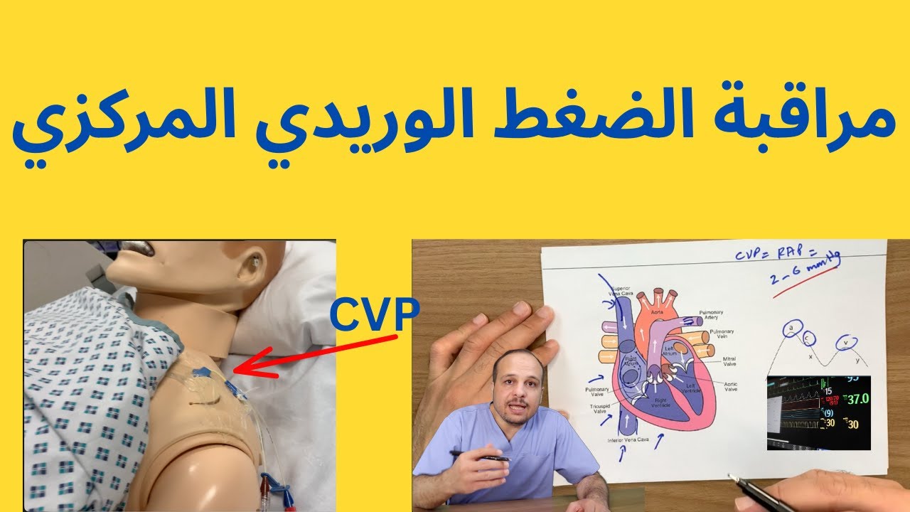 قياس ضغط القسطرة الوريدية