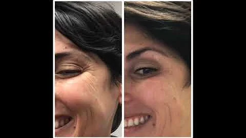 7 day Botox Journey