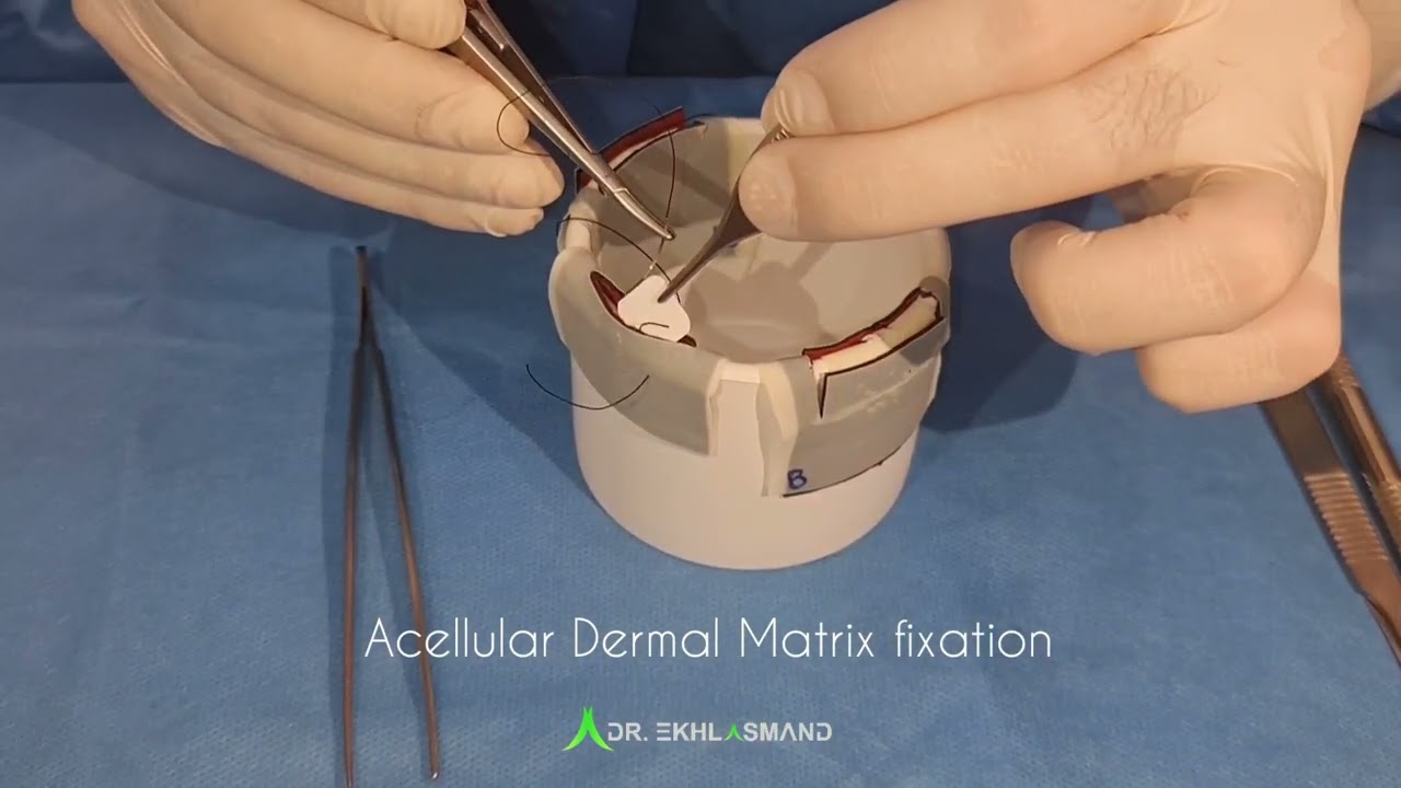 Acellular Dermal Matrix fixation in case of contour augmentation