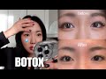 Botox made my eyes SMALLER?! my experience + thoughts