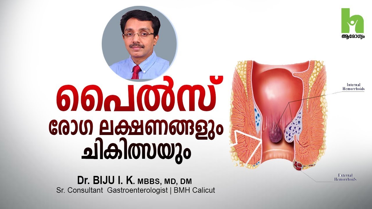 പൈൽസ് രോഗ ലക്ഷണങ്ങളും ചികിത്സയും | How to get rid of piles ...