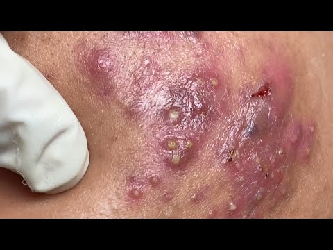 Vídeo: El nòdul de l'acne desapareixerà?