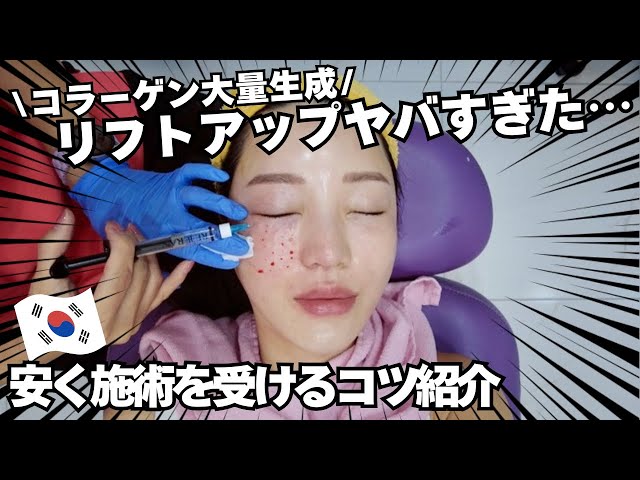 🇰🇷【韓国美容施術】艶肌リフトアップ施術が凄かった…視聴者様限定に