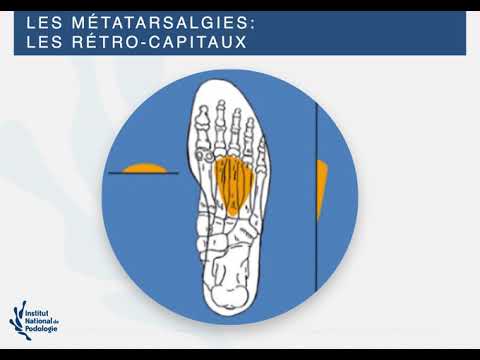 Vidéo: Os Métatarsien - Fracture, Déplacement, Structure