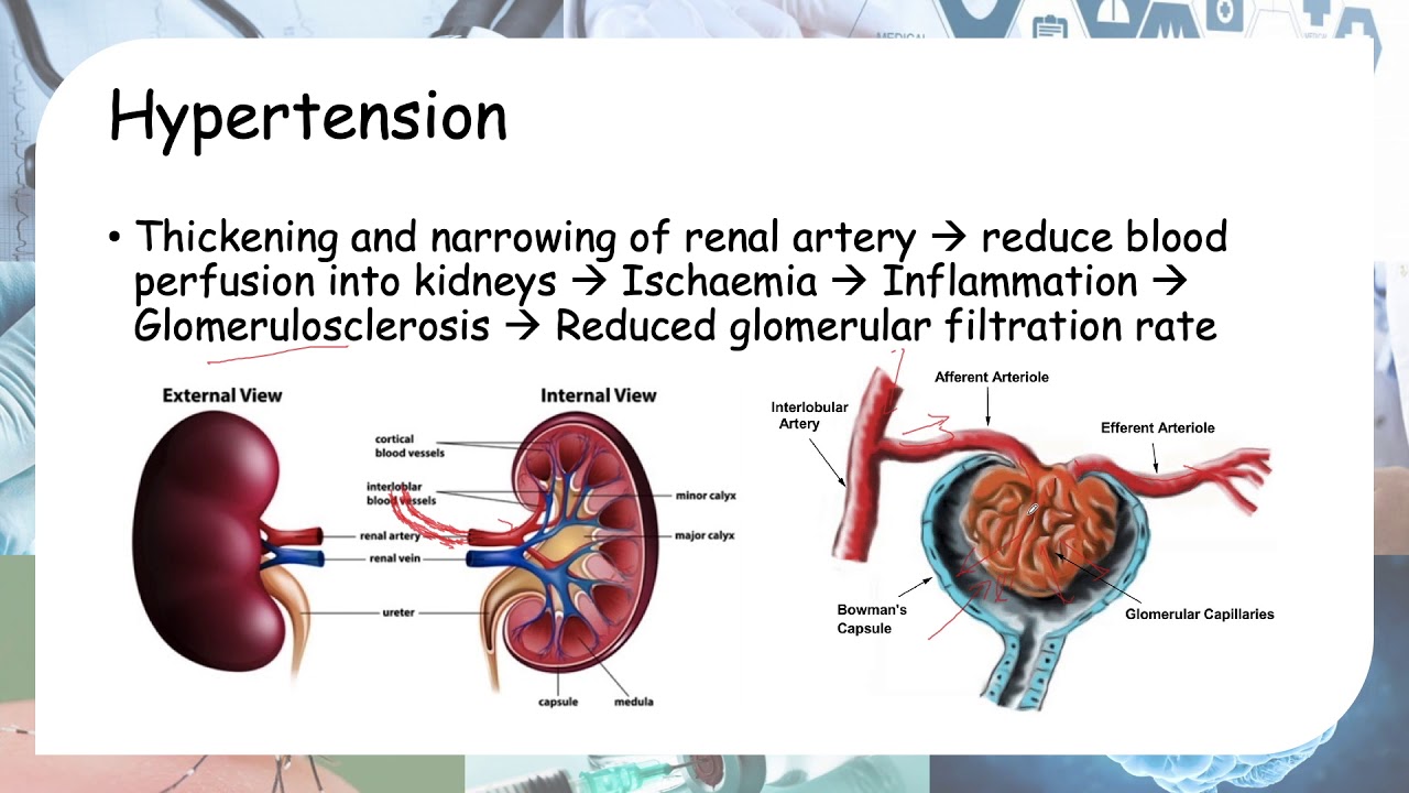 how-diabetes-and-hypertension-leads-to-kidney-failure-youtube