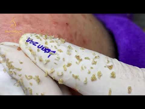 BLACKHEADS EXTRACTION (249) | Loan Nguyen