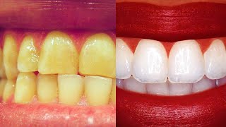 Make Yellow Teeth White with This Home Teeth Whitening Ramady