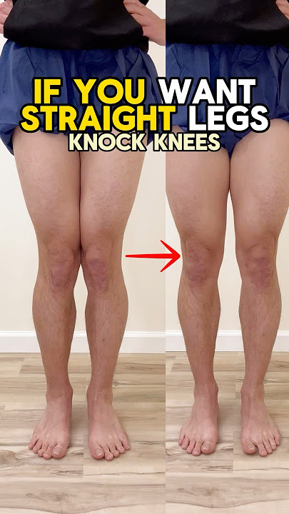 Leg Posture: How to fix your knock knee posture!