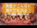 歯茎の腫れと出血は歯ブラシで治せる