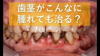 歯茎の腫れと出血は歯ブラシで治せる
