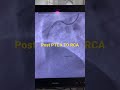 Inferior wall mi  post angioplasty