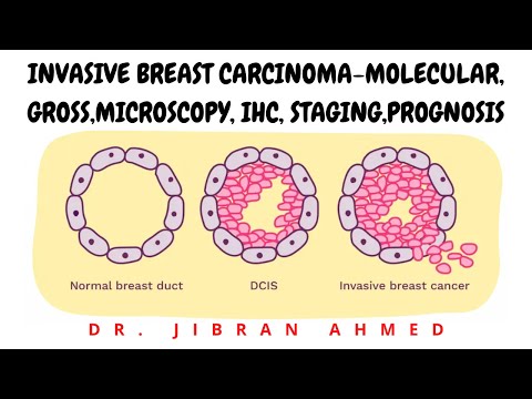 Video: Er biopsi nødvendig for fibroadenom?