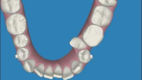 Invisalign clincheck lower arches from www.myinvisalignblog.com blog