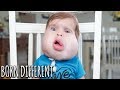 Gavin: Our Little Boy With Facial Cysts | BORN DIFFERENT